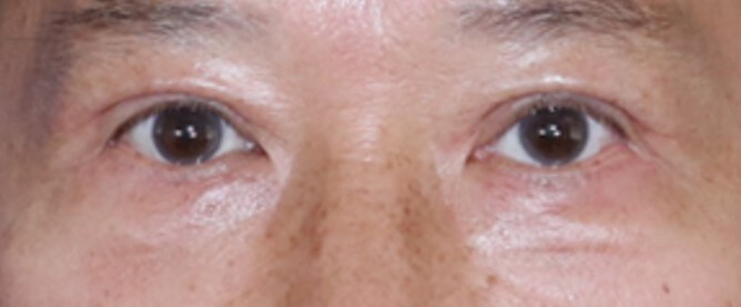 Lower Eyelid Surgery After