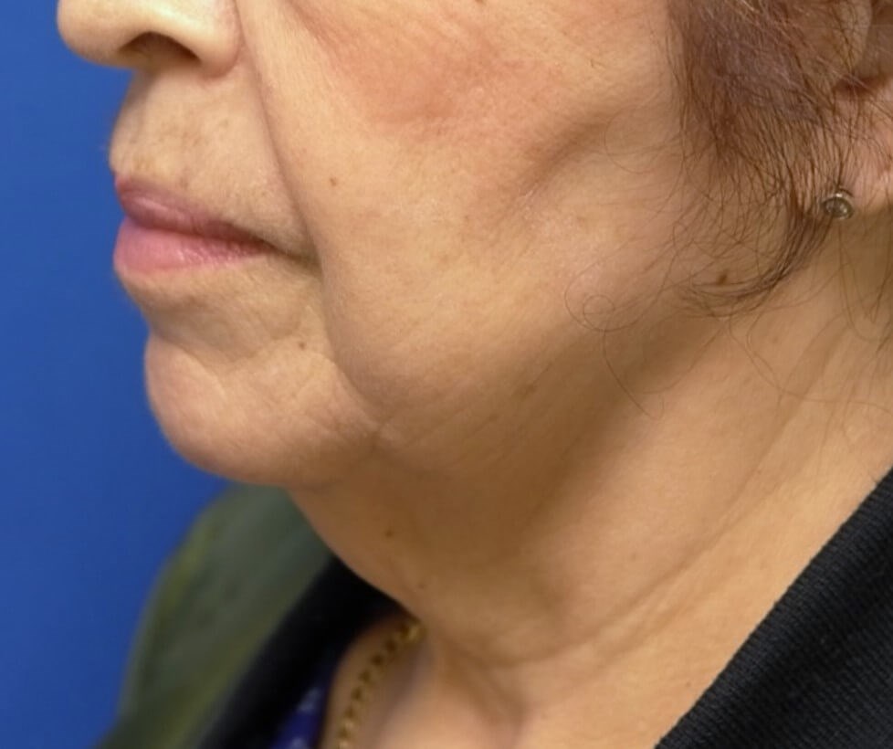 Facelift Surgery Before