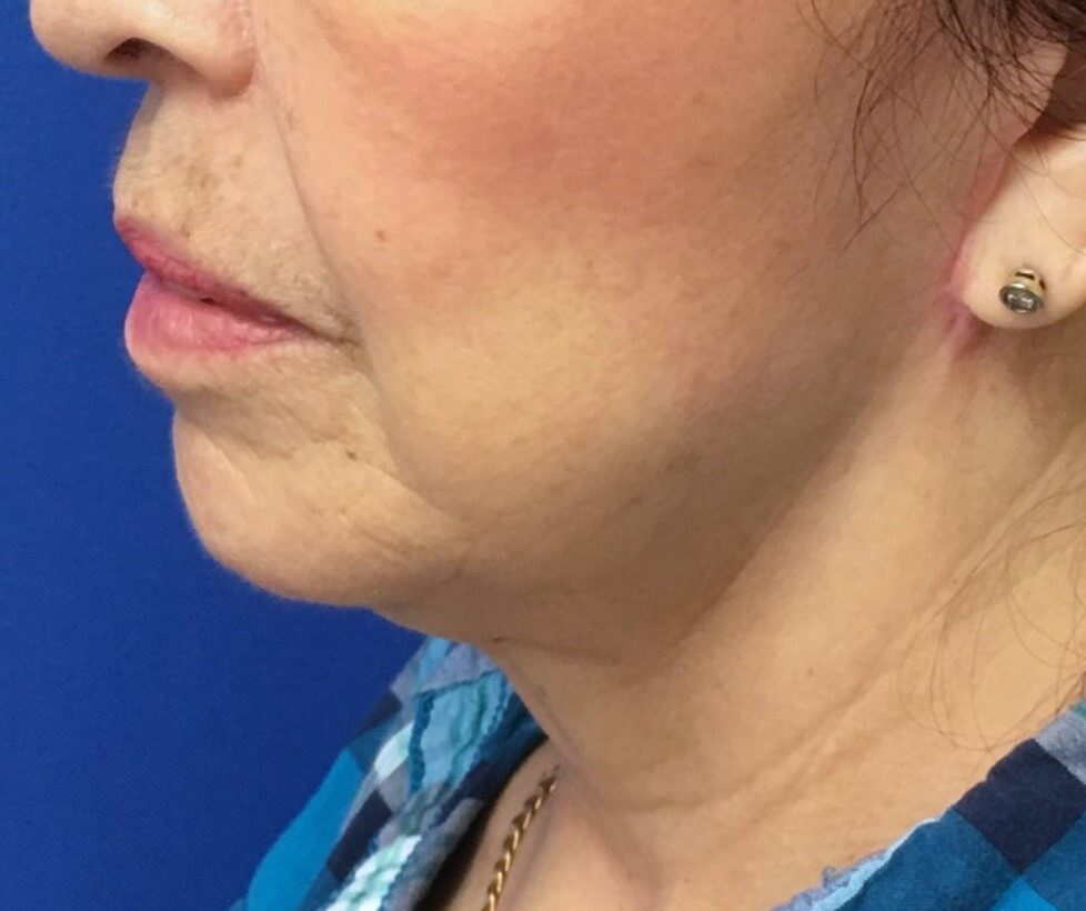 Facelift Surgery After