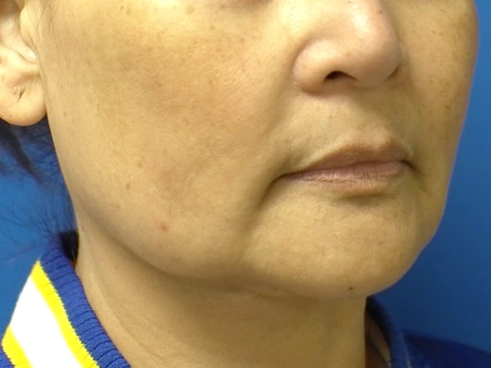 Facelift Surgery Before