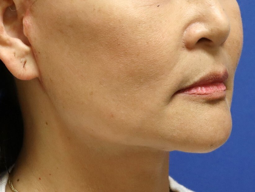 Facelift Surgery After