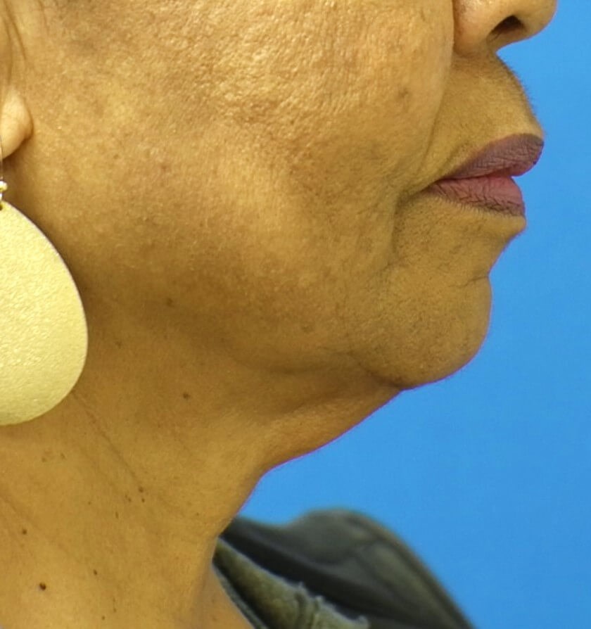Facelift Surgery Before