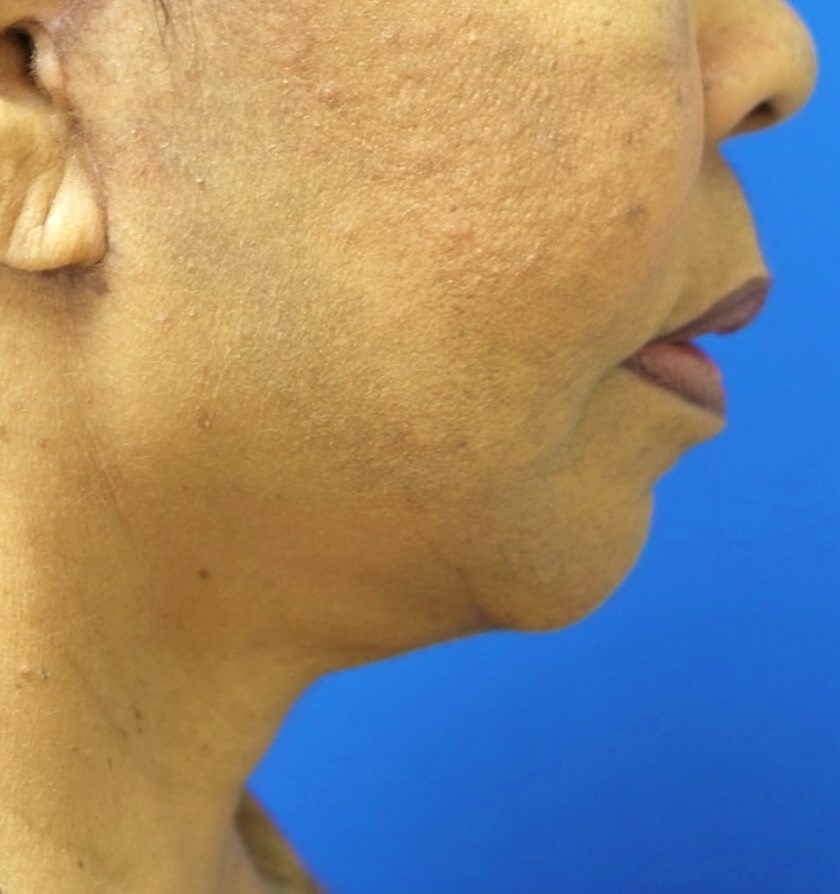 Facelift Surgery After