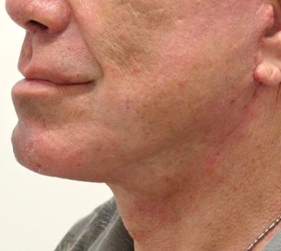 Facelift Surgery After