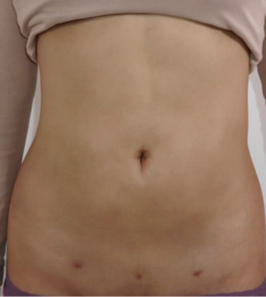 Abdominal Liposuction After