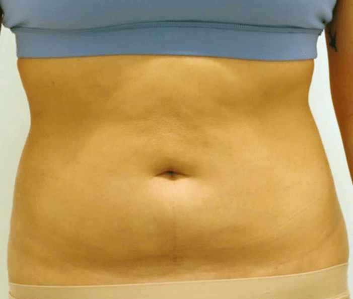 Abdominal Liposuction After