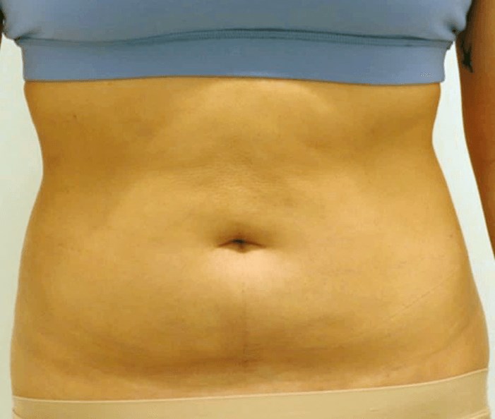 Abdominal Liposuction After