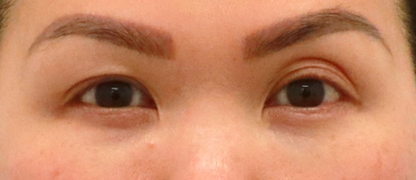 Upper Eyelid Surgery Before