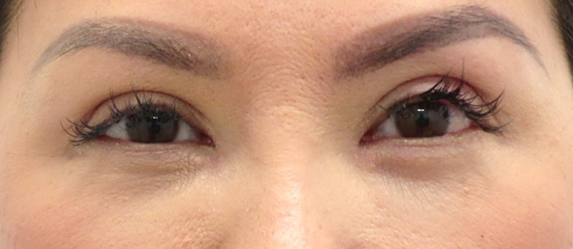 Upper Eyelid Surgery After