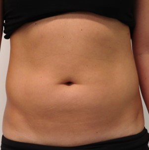 Abdominal Liposuction Before