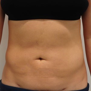 Abdominal Liposuction After