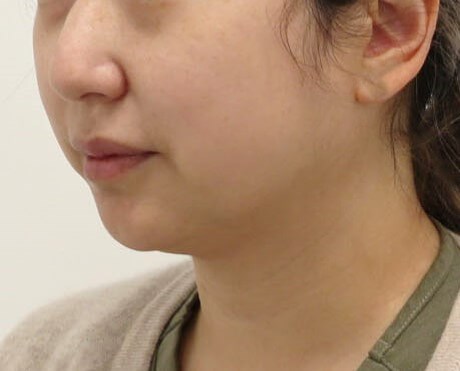 Chin Liposuction Before