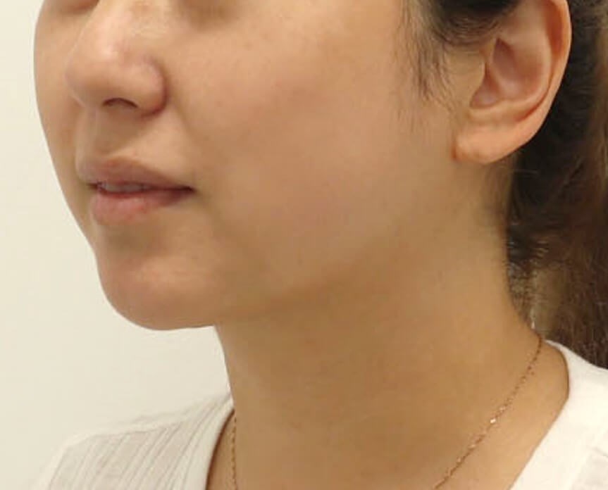 Chin Liposuction After