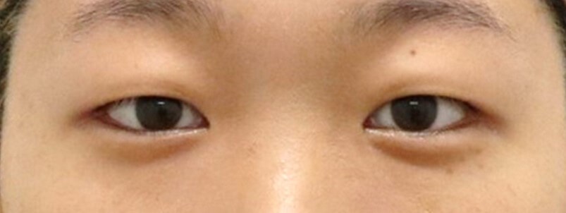 Asian Eyelid Surgery Before
