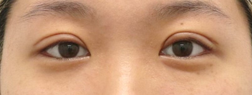 Asian Eyelid Surgery After