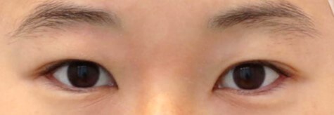 Upper Eyelid Surgery Before