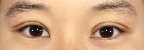 Upper Eyelid Surgery After