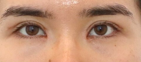 Asian Eyelid Surgery After