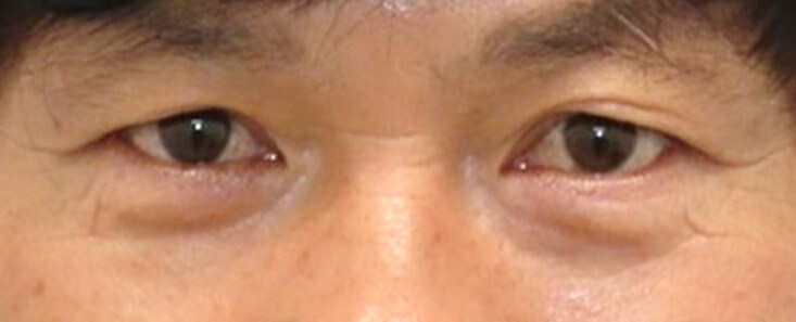Upper Eyelid Surgery Before