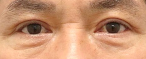 Upper Eyelid Surgery After