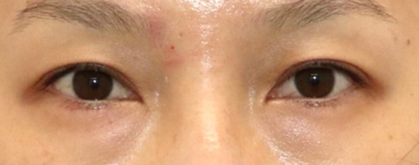 Asian Eyelid Surgery Before