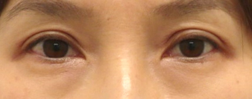 Asian Eyelid Surgery After