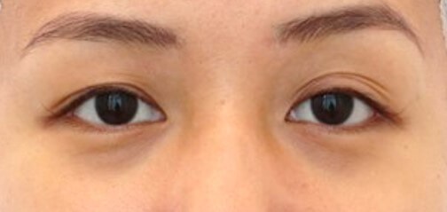 Upper Eyelid Surgery Before