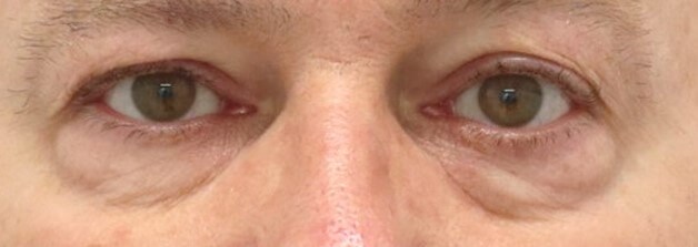 Upper and Lower Eyelid Surgery Before
