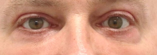 Upper and Lower Eyelid Surgery After