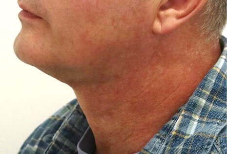 Neck Liposuction Surgery After
