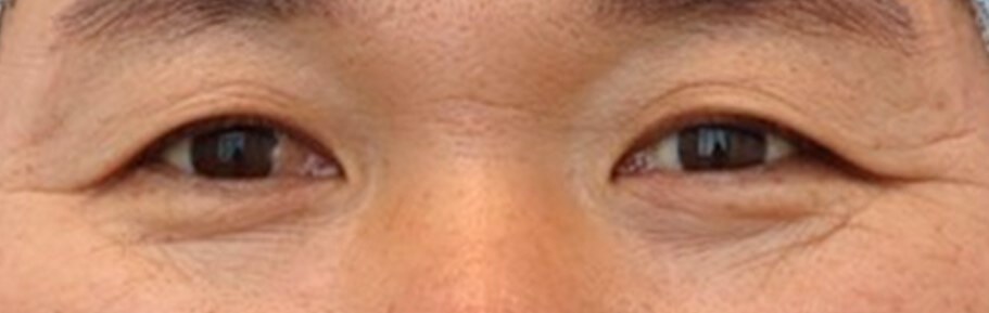 Upper Eyelid Surgery Before