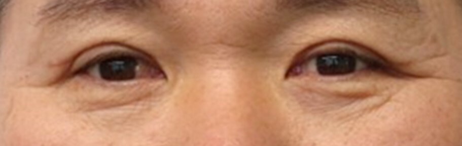 Upper Eyelid Surgery After