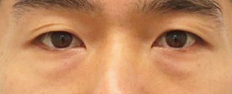 Asian and Lower Eyelid Surgery Before