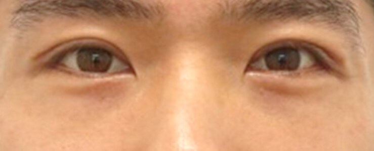 Asian and Lower Eyelid Surgery After