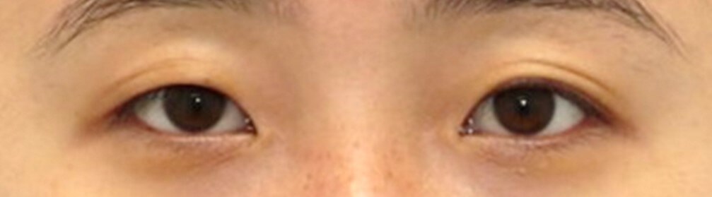Asian Eyelid Surgery Before