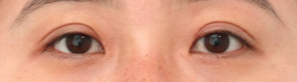 Asian Eyelid Surgery After