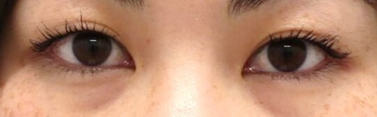 Asian Eyelid Surgery Before
