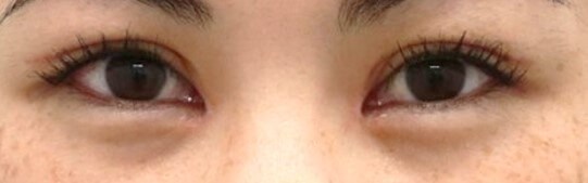 Asian Eyelid Surgery After