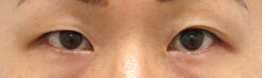Asian Eyelid Surgery Before
