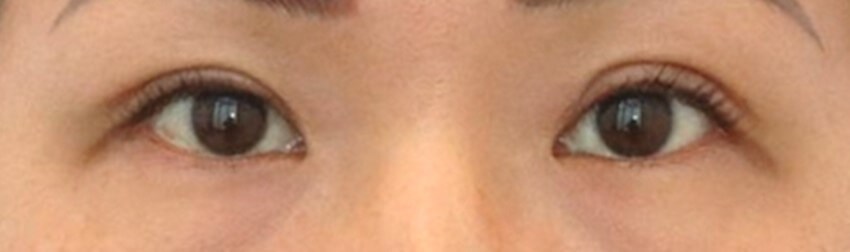Asian Eyelid Surgery After