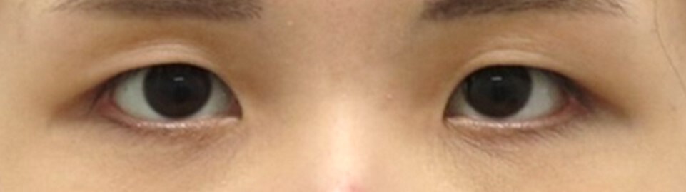 Asian Eyelid Surgery Before