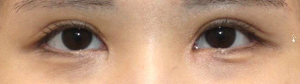Asian Eyelid Surgery After