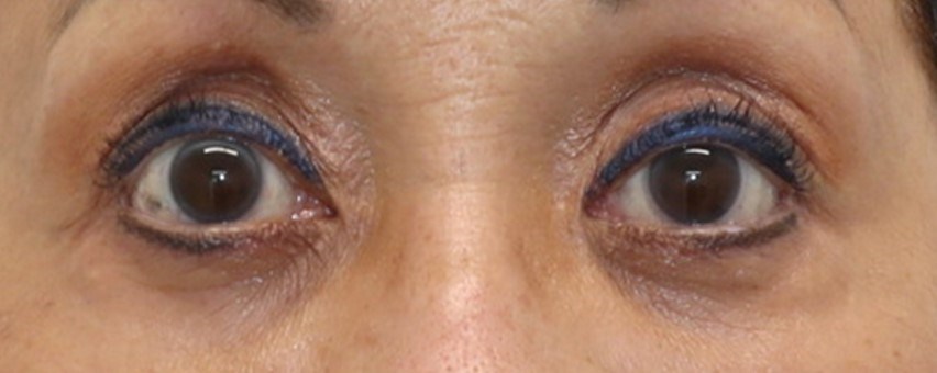 Upper Eyelid Surgery After