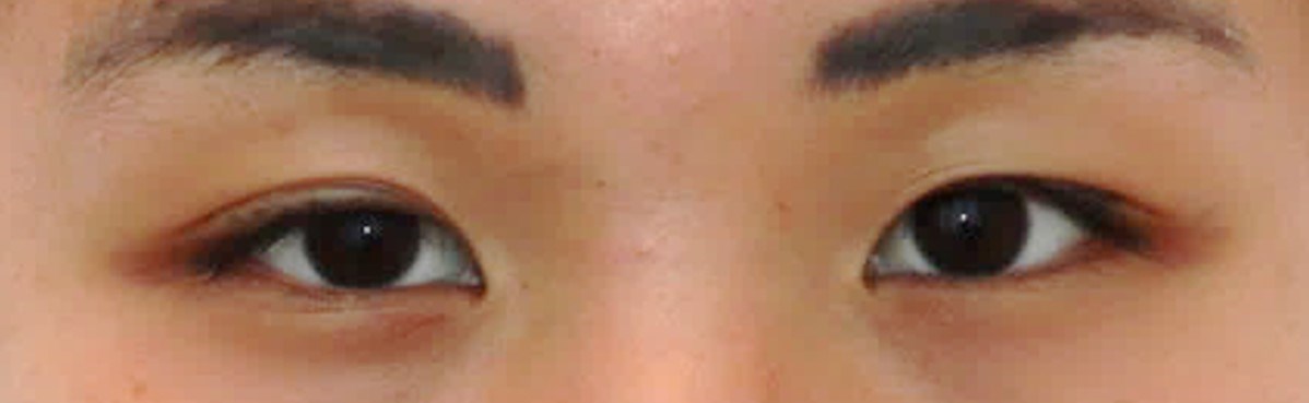 Upper Eyelid Surgery Before