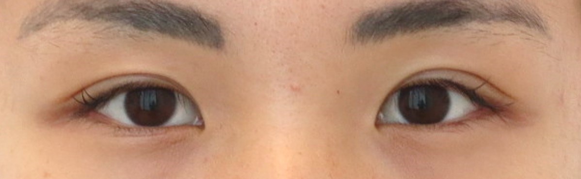 Upper Eyelid Surgery After