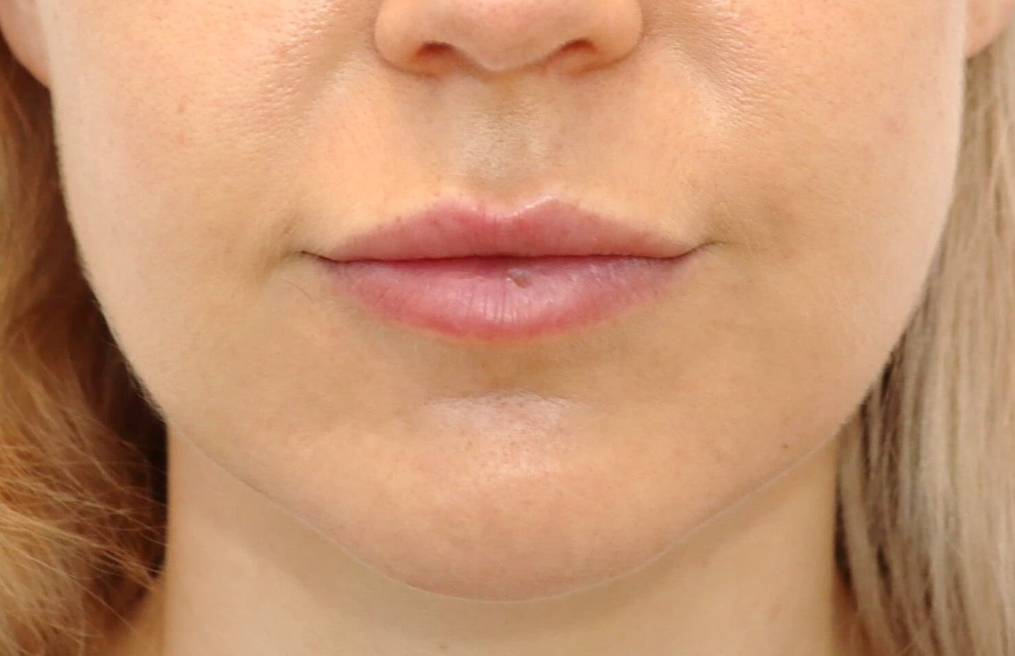 Buccal Fat Removal Before