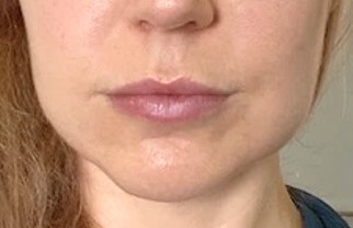 Buccal Fat Removal After