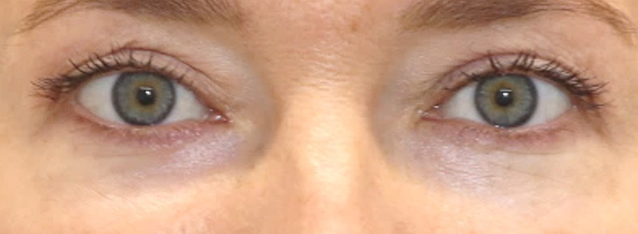Upper, Lower Eyelid Surgery After