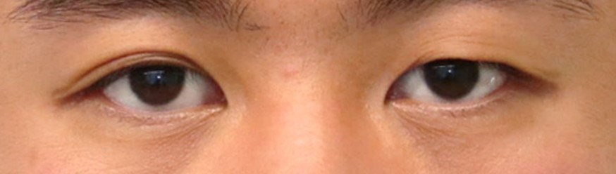 Asian Eyelid Surgery Before