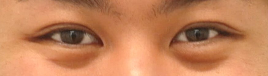 Asian Eyelid Surgery After